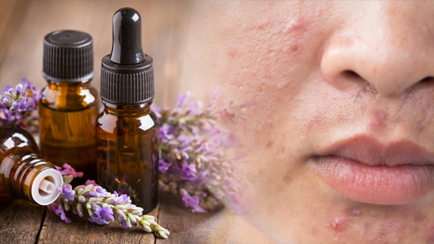 levender-oil-treating-Oily-Skin-and-acne