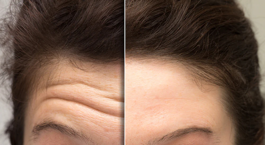ways to reduce wrinkles